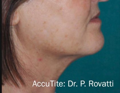 Facetite Before & After Patient #7259