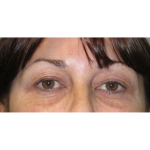 Upper Blepharoplasty Before & After Patient #7347