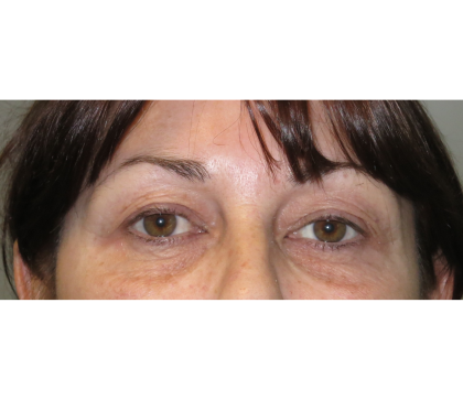 Upper Blepharoplasty Before & After Patient #7347