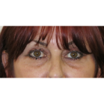 Upper Blepharoplasty Before & After Patient #7347