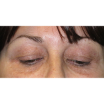 Upper Blepharoplasty Before & After Patient #7347