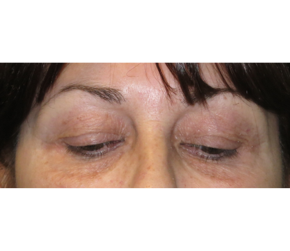 Upper Blepharoplasty Before & After Patient #7347