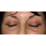 Upper Blepharoplasty Before & After Patient #7347