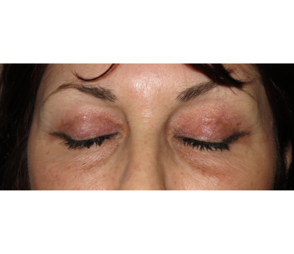 Upper Blepharoplasty Before & After Patient #7347