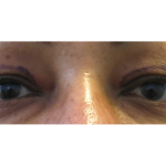 Upper Blepharoplasty Before & After Patient #7348