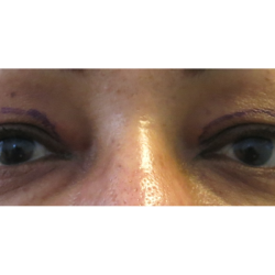 Upper Blepharoplasty Before & After Patient #7348