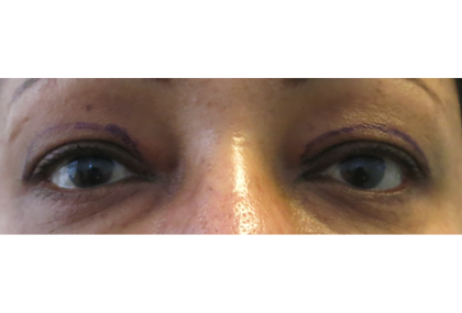 Upper Blepharoplasty Before & After Patient #7348
