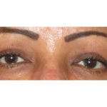 Upper Blepharoplasty Before & After Patient #7348
