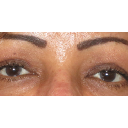 Upper Blepharoplasty Before & After Patient #7348