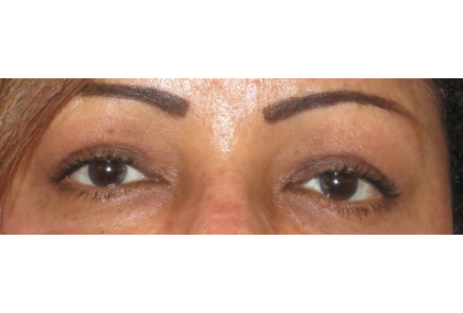 Upper Blepharoplasty Before & After Patient #7348