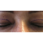 Upper Blepharoplasty Before & After Patient #7348