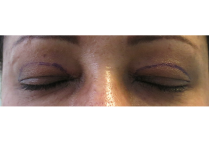 Upper Blepharoplasty Before & After Patient #7348