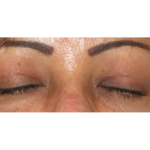 Upper Blepharoplasty Before & After Patient #7348