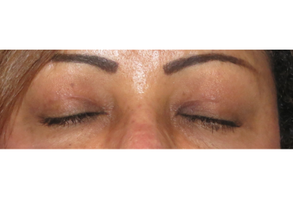 Upper Blepharoplasty Before & After Patient #7348