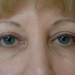 Upper Blepharoplasty Before & After Patient #7349