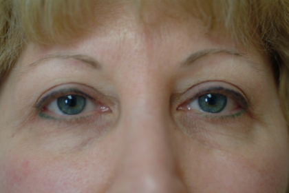 Upper Blepharoplasty Before & After Patient #7349