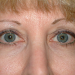 Upper Blepharoplasty Before & After Patient #7349