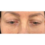 Upper Blepharoplasty Before & After Patient #7350