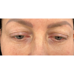 Upper Blepharoplasty Before & After Patient #7350