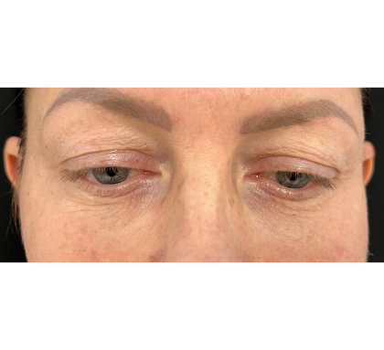 Upper Blepharoplasty Before & After Patient #7350