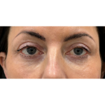 Upper Blepharoplasty Before & After Patient #7350
