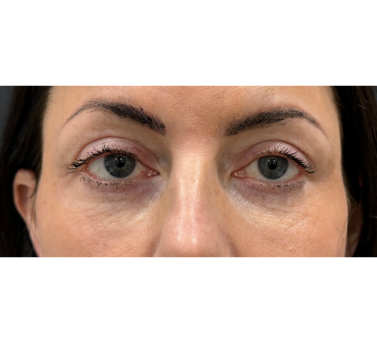 Upper Blepharoplasty Before & After Patient #7350