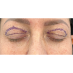 Upper Blepharoplasty Before & After Patient #7350