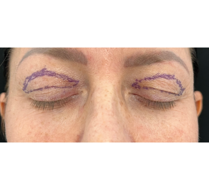 Upper Blepharoplasty Before & After Patient #7350