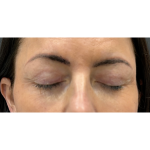 Upper Blepharoplasty Before & After Patient #7350