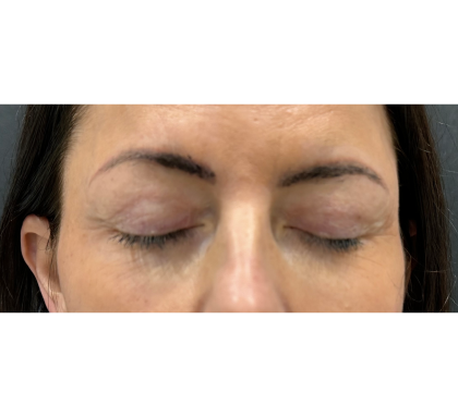 Upper Blepharoplasty Before & After Patient #7350