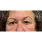 Upper Blepharoplasty Before & After Patient #7365