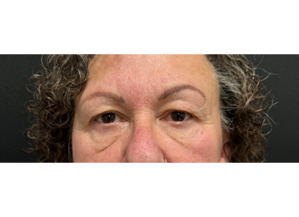 Upper Blepharoplasty Before & After Patient #7365