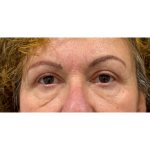 Upper Blepharoplasty Before & After Patient #7365