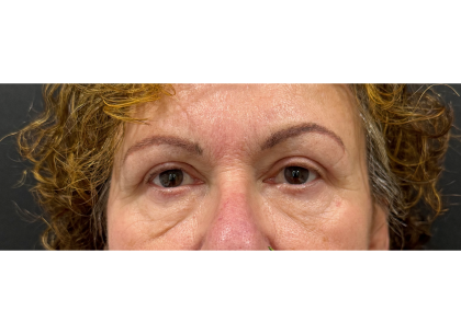 Upper Blepharoplasty Before & After Patient #7365