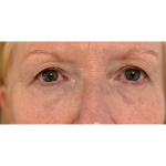 Upper Blepharoplasty Before & After Patient #7366