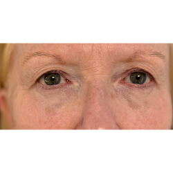 Upper Blepharoplasty Before & After Patient #7366