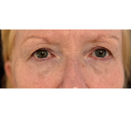 Upper Blepharoplasty Before & After Patient #7366