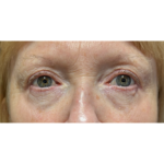 Upper Blepharoplasty Before & After Patient #7366