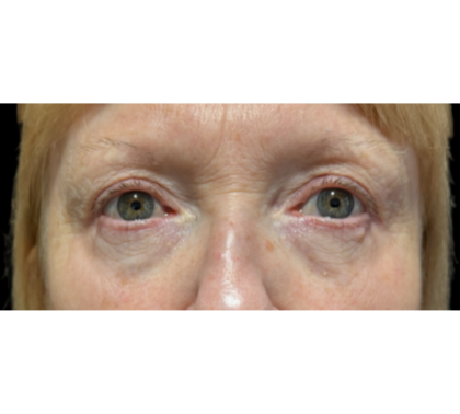 Upper Blepharoplasty Before & After Patient #7366