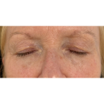 Upper Blepharoplasty Before & After Patient #7366