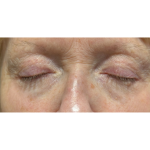 Upper Blepharoplasty Before & After Patient #7366