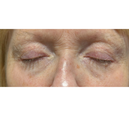 Upper Blepharoplasty Before & After Patient #7366